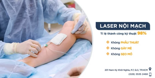Chỉ 30 phút Laser – Điều trị dứt điểm chân nặng mỏi, nổi gân vì suy giãn tĩnh mạch