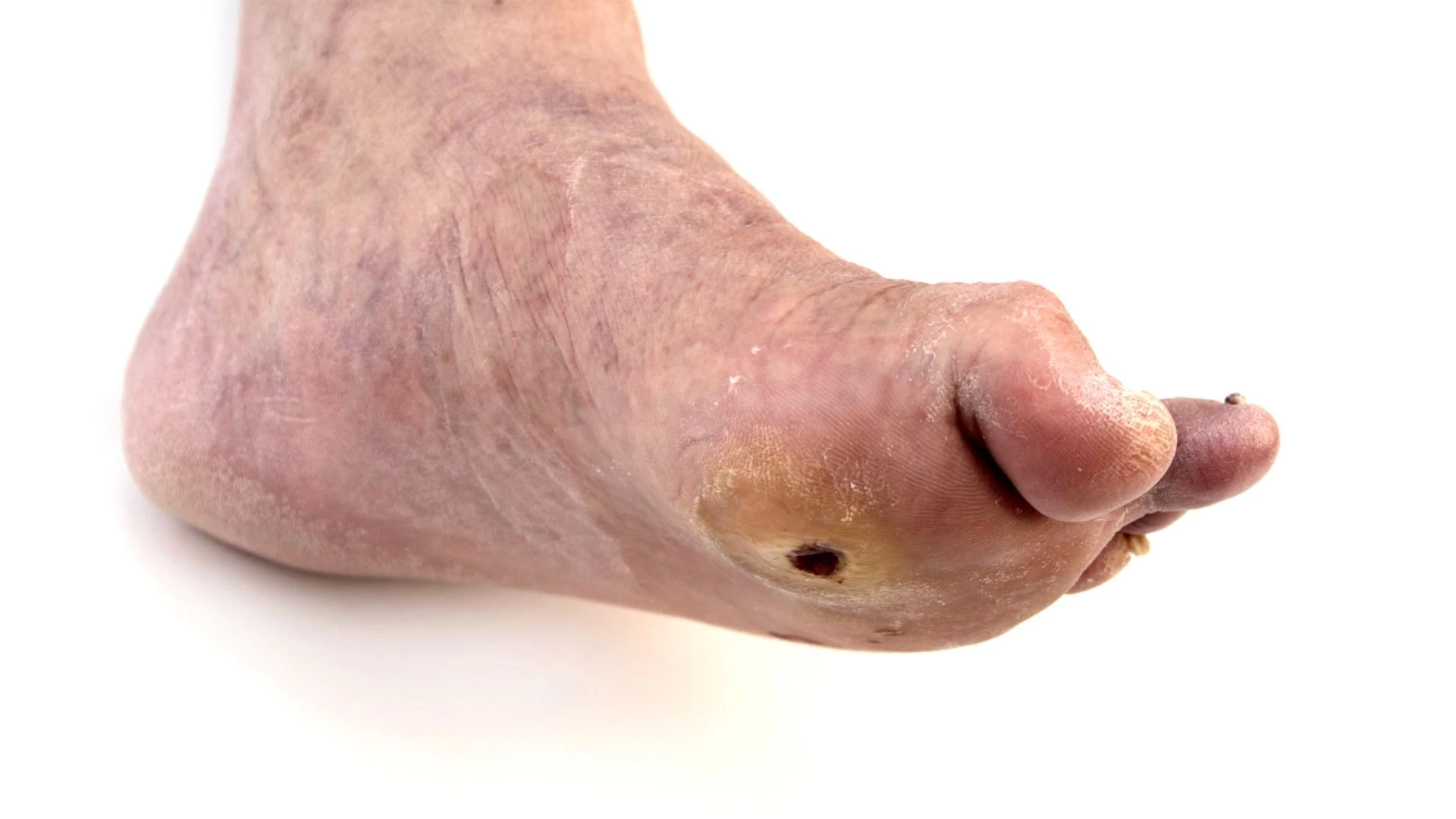 Bệnh nhân tiểu đường có nguy cơ tử vong cao nếu bị loét