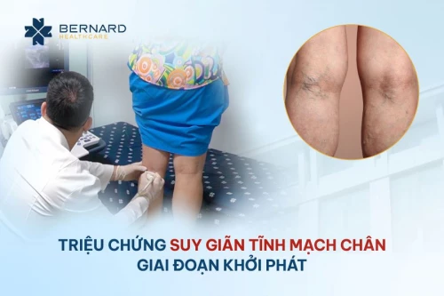 Vì sao suy giãn tĩnh mạch tái phát sau điều trị?