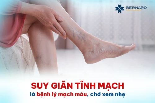 Suy giãn tĩnh mạch là bệnh lý mạch máu, chớ xem nhẹ