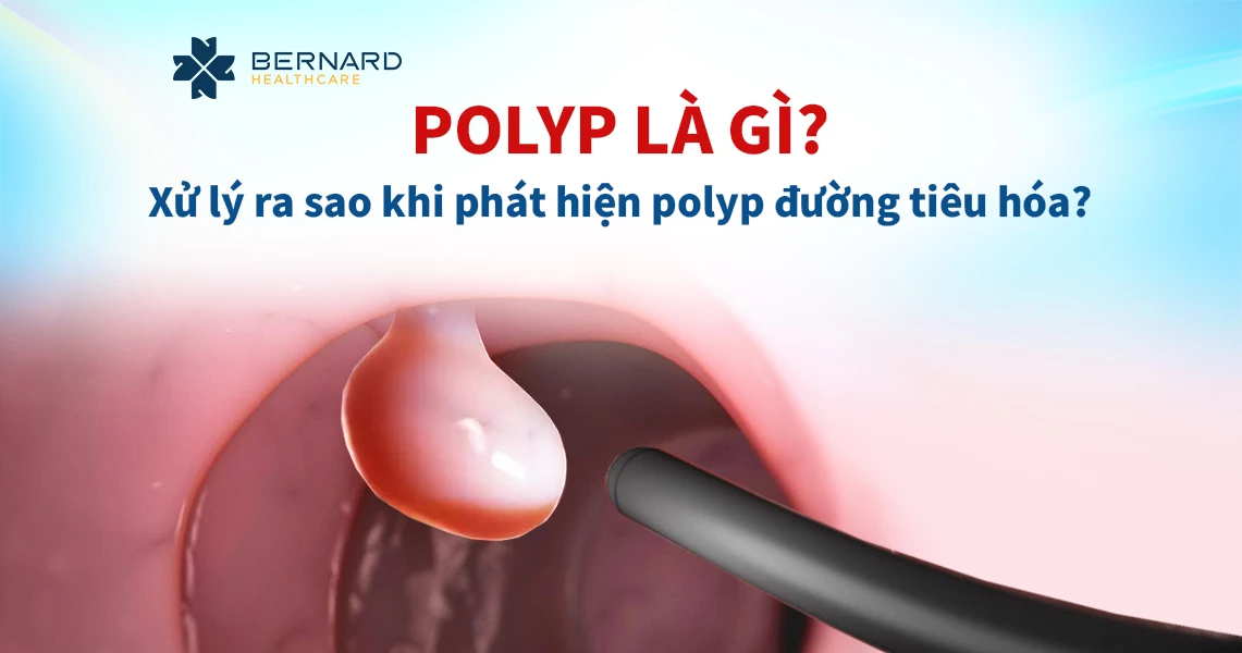 Polyp là gì? Nội soi phát hiện polyp phải xử lý như thế nào?