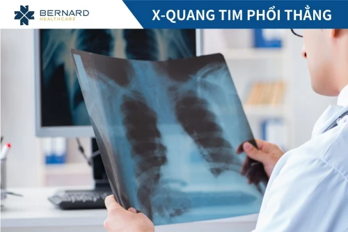 Chụp X-quang tim phổi thẳng