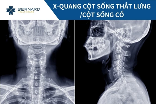 Chụp X-quang cột sống thắt lưng/cột sống cổ