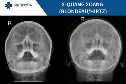 Chụp X-quang Blondeau/hirtz