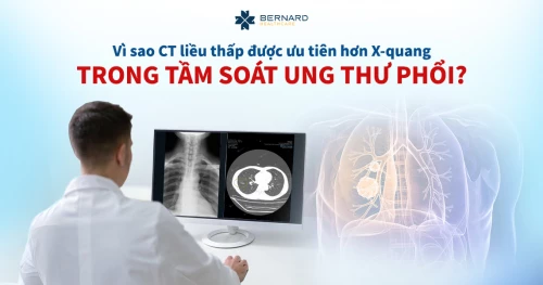 Vì sao CT liều thấp được ưu tiên hơn X-quang trong tầm soát ung thư phổi?