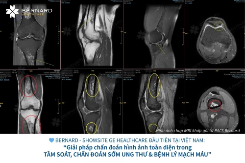 Tưởng đau nhức do tuổi tác, bất ngờ phát hiện nhồi máu xương nguy hiểm