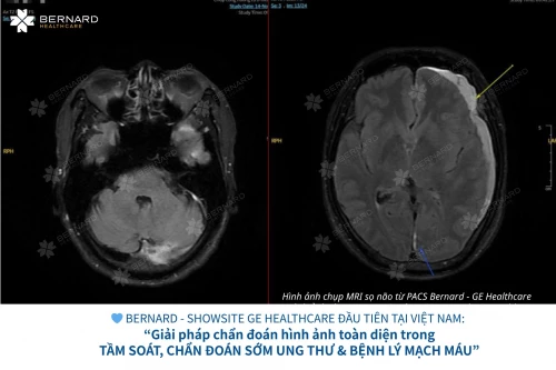 Phát hiện tụ máu dưới màng cứng nhờ chụp MRI sọ não tại Bernard Healthcare