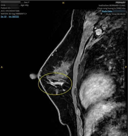 Chưa có dấu hiệu bất thường vẫn phát hiện ung thư vú nhờ MRI chuyên sâu