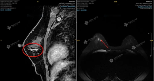 Các giai đoạn tiến triển của ung thư vú