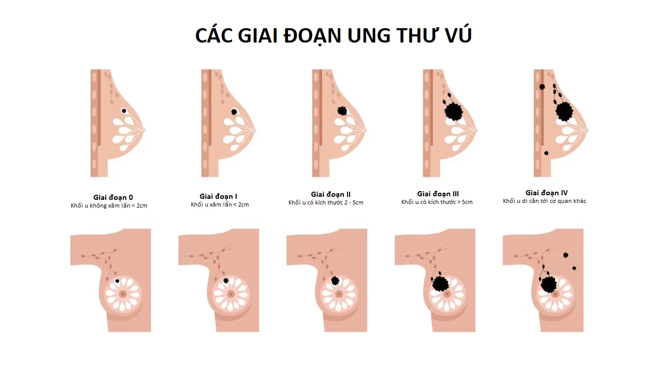 UNG THƯ GIAI ĐOẠN 3 CÓ THỂ ĐIỀU TRỊ ĐƯỢC VỚI PHÁC ĐỒ TÍCH CỰC KẾT HỢP NHIỀU PHƯƠNG PHÁP