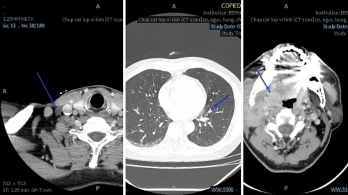 Ung thư amidan giai đoạn 3 dù không triệu chứng và hành trình tìm lời giải qua double-check với Nhật Bản