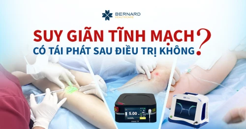 Suy giãn tĩnh mạch có tái phát sau điều trị không?