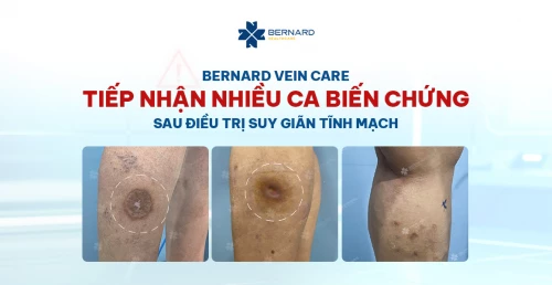 Bernard Vein Care tiếp nhận nhiều ca biến chứng sau điều trị suy giãn tĩnh mạch
