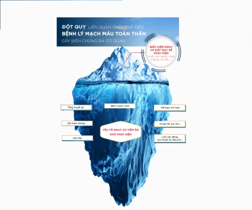 Đột quỵ & nguyên lý “tảng băng trôi”