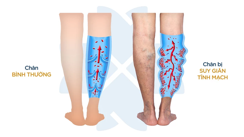 Các thói quen có hại cho bệnh lý suy giãn tĩnh mạch