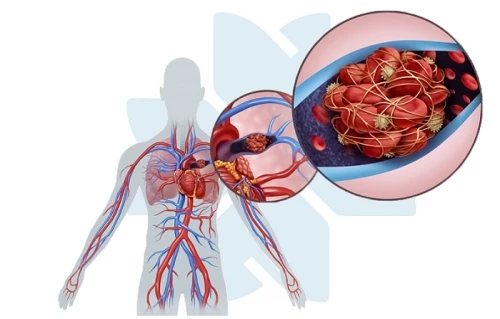 Huyết khối tĩnh mạch sâu có thể gây đột tử