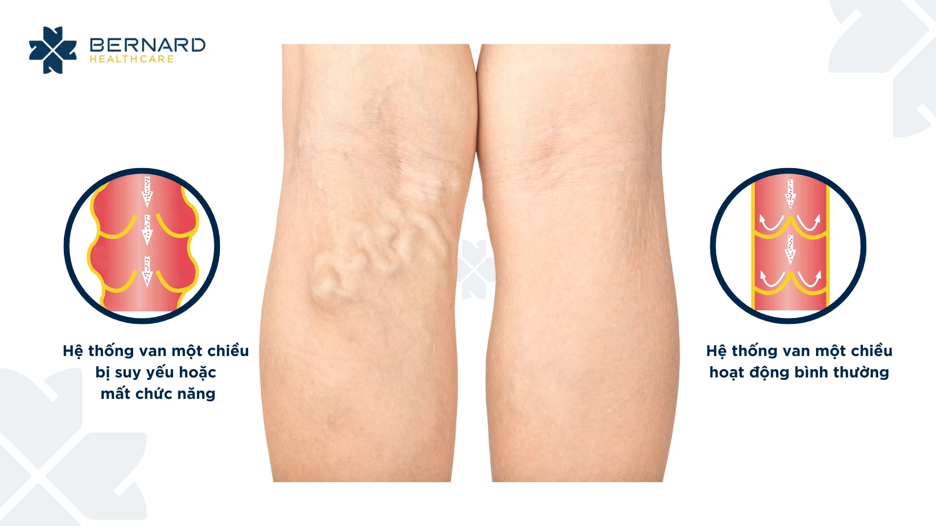 suy-gian-tinh-mach-chi-duoi-bernard