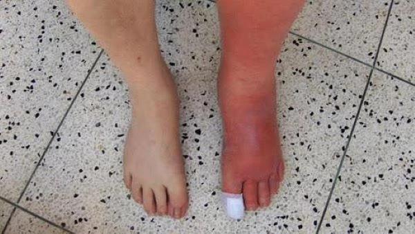 Bệnh nhân bị vết thương ngón cái diễn tiến nhiễm trùng bàn chân với biểu hiện sưng, đỏ lan rộng toàn bộ bàn chân