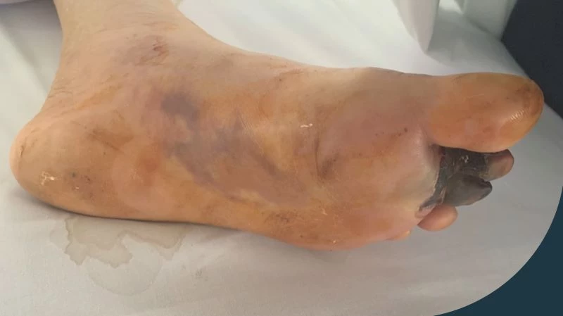 Hình ảnh thực tế chân bệnh nhân bị tím tái, hoại tử ngón chân do tắc động mạch 