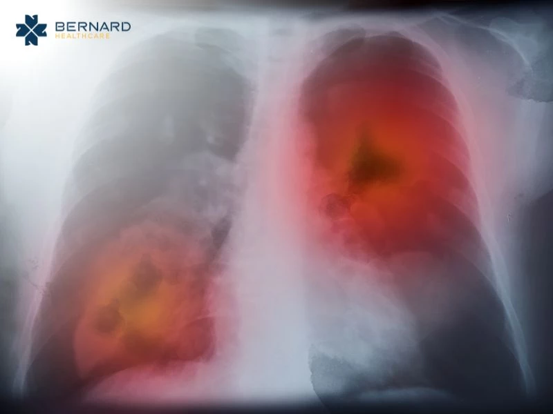 Theo thống kê ung thư phổi là một trong những căn bệnh nguy hiểm có số lượng bệnh nhân được ghi nhận nhiều nhất hiện nay.