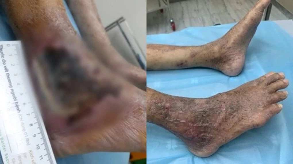 Một ca loét bàn chân nhiễm trùng lan rộng, suýt phải cưa chân để tránh nhiễm trùng huyết. Hình từ trái sang phải: Trước và sau điều trị vết thương tại Bernard Wound Care