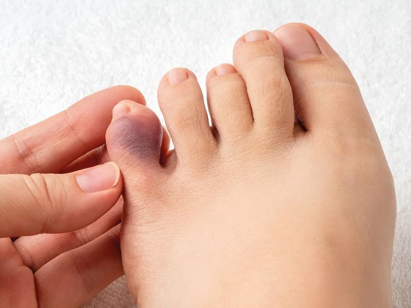 Ngón chân tím tái là dấu hiệu ban đầu của vết loét động mạch chi dưới