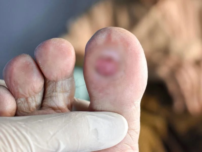 Vết thương bàn chân lâu lành là biến chứng từ bệnh lý đái tháo đường