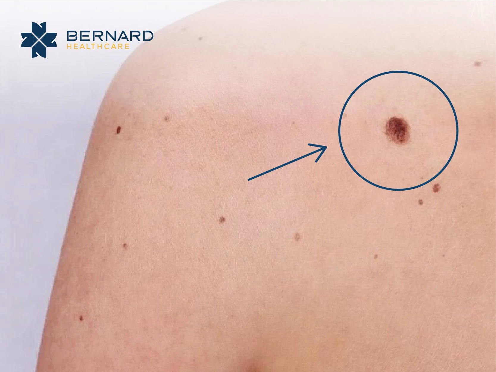 Nếu nhận thấy những dấu hiệu khác thường trên da, bạn hãy nhanh chóng khám sàng lọc để tầm soát ung thư da